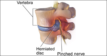 symptôme principal d'une hernie discale